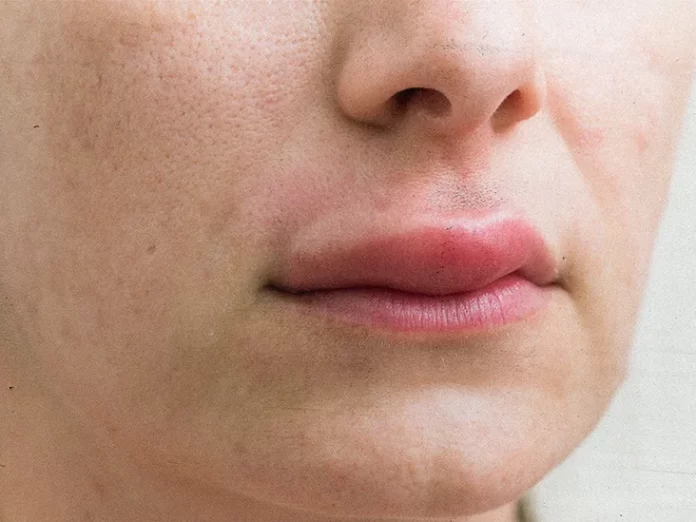 Swollen Lips problem solution
