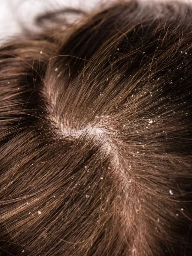 dandruff seborrhea, problem scalp
