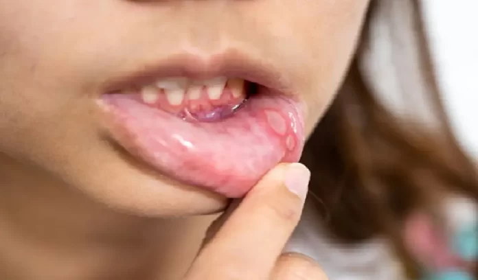 Mouth Ulcer, Mouth Ulcer Home Remedies