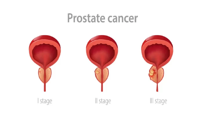Prostate Cancer Prostate Cancer, Jo Biden