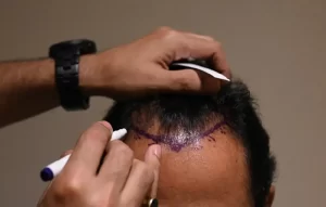 Hair transplant, Men After die Transplant