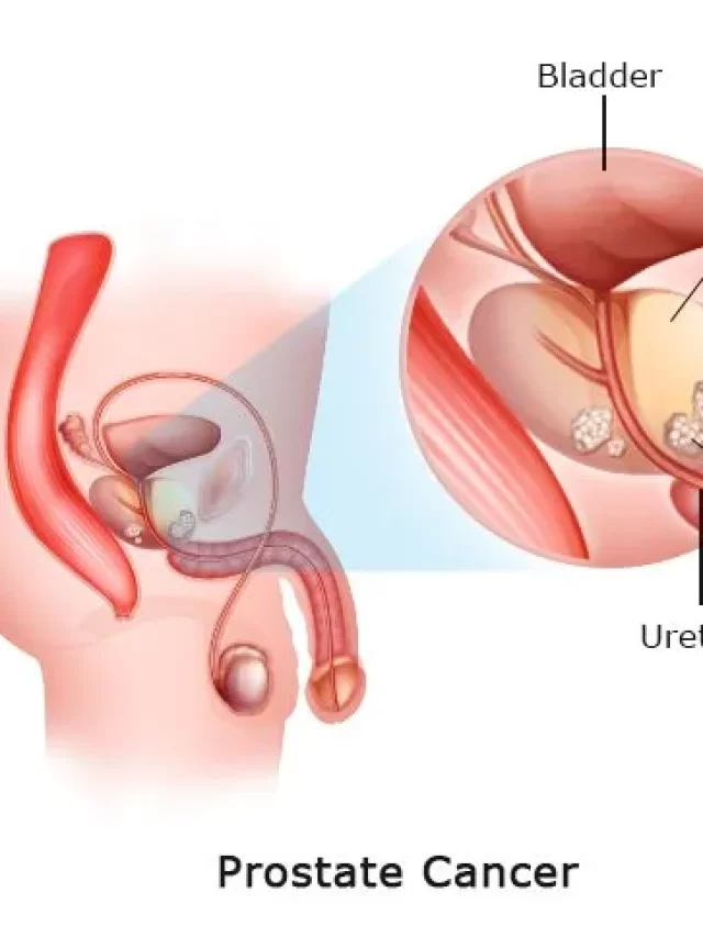 Prostate-Cancer