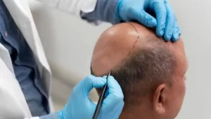 Kanpur Hair Transplant News