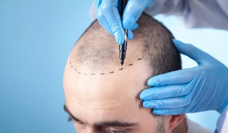 Kanpur Hair Transplant Case: गलत हाथों में गई जिंदगी, जानिए कौन कर सकता है ये सर्जरी