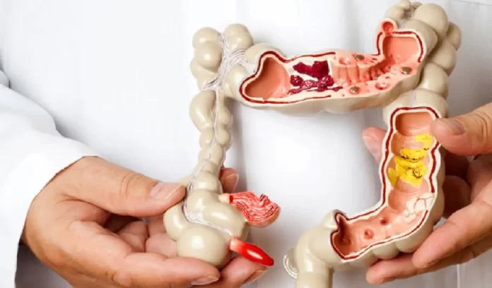 irritable bowel syndrome