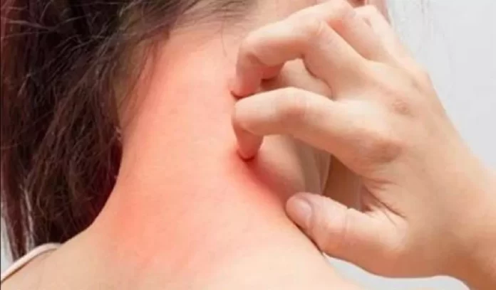 Skin Infections Skin Infections, Precaution for skin Infections