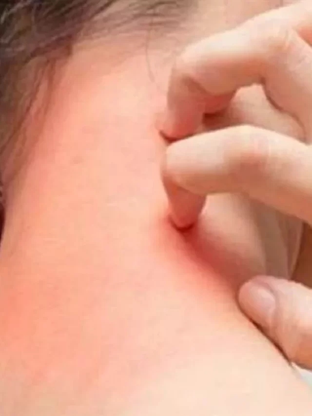 बारिश में त्वचा संक्रमण से बचने के 5 तरीके