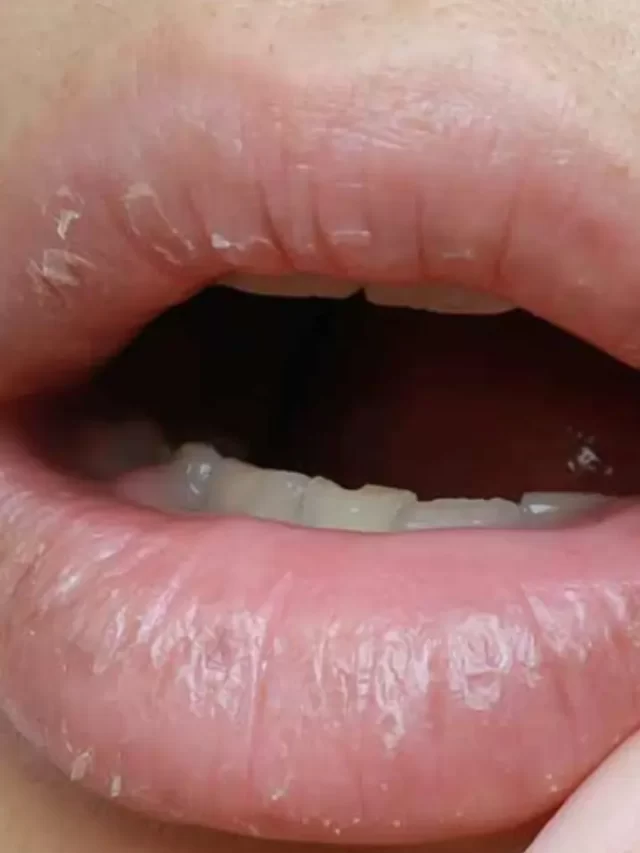 Chapped lips, How to repair Chapped lips
