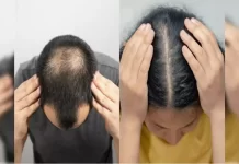 Aloe Vera: गंजेपन से परेशान हैं? जानिए क्या वाकई एलोवेरा कर सकता है कमाल Aloe vera hair Treatment